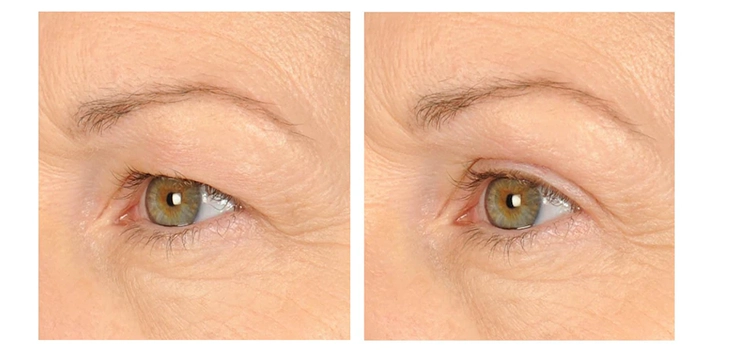 woman's before and after use of contours rx